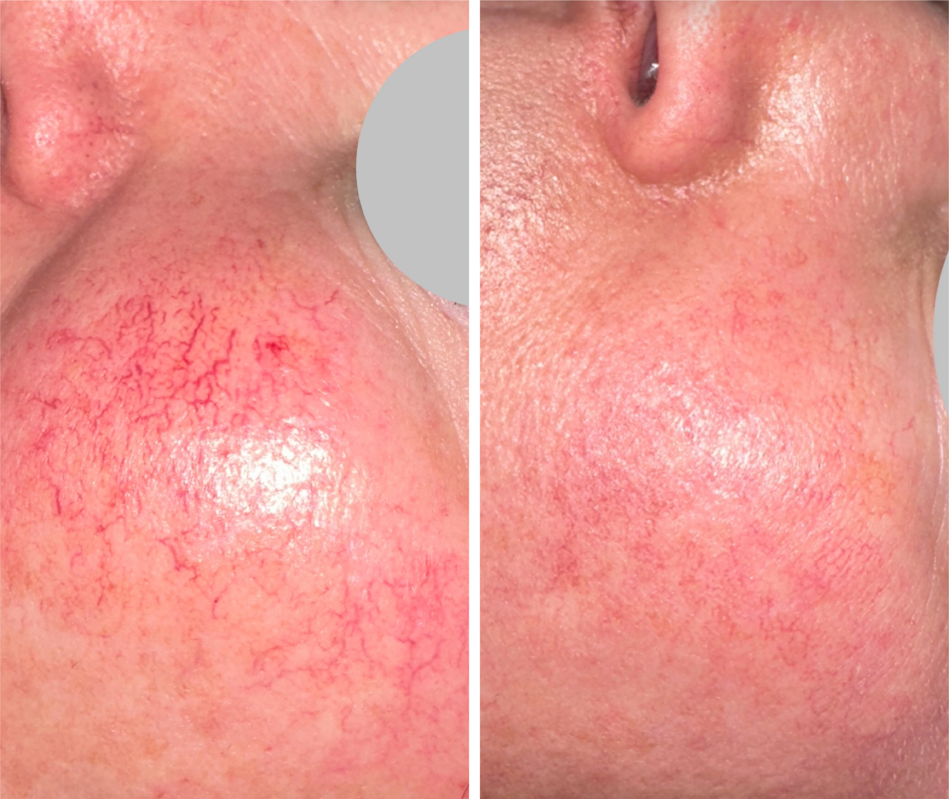 After treatment placeholder